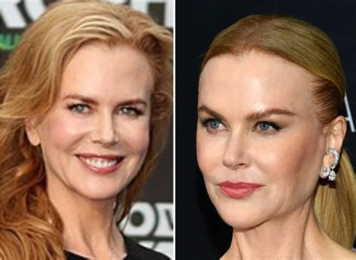 Unveiling The Truth: Did Nicole Kidman Get Botox?